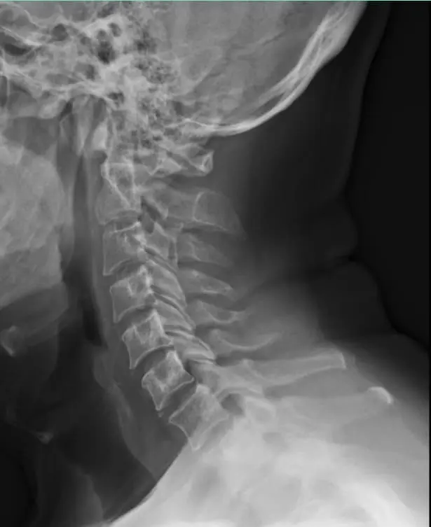 Diagnóstico de columna